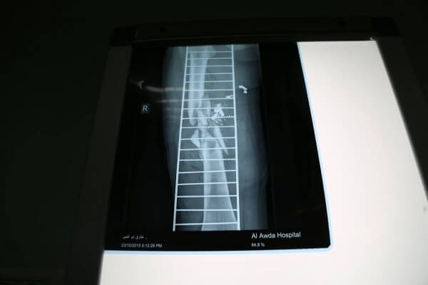 Tarek Masood x-ray of his leg showing shattered femur, following his hospitalization at al-Awda Hospital in Gaza